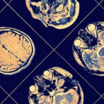 Neurocrine Halts Schizophrenia Drug Development Trial Due to Failure