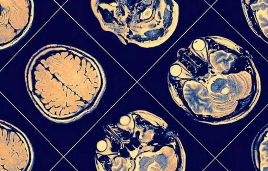 Neurocrine Halts Schizophrenia Drug Development Trial Due to Failure
