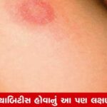 મધુપ્રમેહના લક્ષણો: ત્વચામાં દેખાય આ ફેરફાર, તો જાગૃત થઇ જાઓ