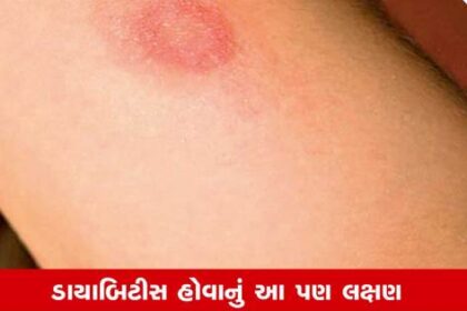 મધુપ્રમેહના લક્ષણો: ત્વચામાં દેખાય આ ફેરફાર, તો જાગૃત થઇ જાઓ