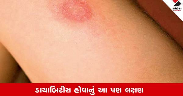 મધુપ્રમેહના લક્ષણો: ત્વચામાં દેખાય આ ફેરફાર, તો જાગૃત થઇ જાઓ