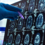 Brain Tumor Day: મગજની ગાંઠના દર વર્ષે 28000 નવા કેસ, 24000થી વધુના મૃત્યુ, જાણો લક્ષણો ડો. સમિર દલાલ બ્રેઈન ટ્યુમર પેશન્ટ બન્યા; જરૂરી નિવેદન છે: મગજની ગાંઠના દર વર્ષે 28000 નવા કેસ સાથે 24000થી વધુ મૃત્યુના આંકડાઓ હાજર છે. મગજની ગાંઠ ઘણી વાર ગંભીર પ્રકારની હોય છે જેની બરાબર સમયે ઓળખ ન થાય તો મૃત્યુ પણ થઈ શકે છે.