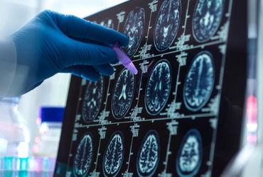 Brain Tumor Day: મગજની ગાંઠના દર વર્ષે 28000 નવા કેસ, 24000થી વધુના મૃત્યુ, જાણો લક્ષણો ડો. સમિર દલાલ બ્રેઈન ટ્યુમર પેશન્ટ બન્યા; જરૂરી નિવેદન છે: મગજની ગાંઠના દર વર્ષે 28000 નવા કેસ સાથે 24000થી વધુ મૃત્યુના આંકડાઓ હાજર છે. મગજની ગાંઠ ઘણી વાર ગંભીર પ્રકારની હોય છે જેની બરાબર સમયે ઓળખ ન થાય તો મૃત્યુ પણ થઈ શકે છે.
